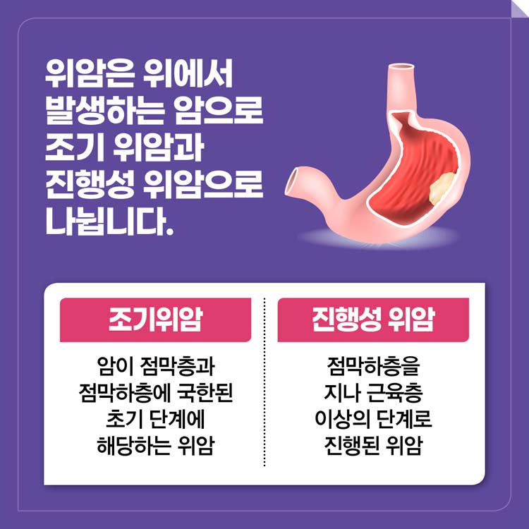 위암은 위에서 발생하는 암으로 조기위암과 진행성 위암으로 나뉩니다.
조기위암 암이 점막층과 점막하층에 국한된 초기 단계에 해당하는 위암
진행성 위암 점막하층을 지나 근육층 이상의 단계로 진행된 위암